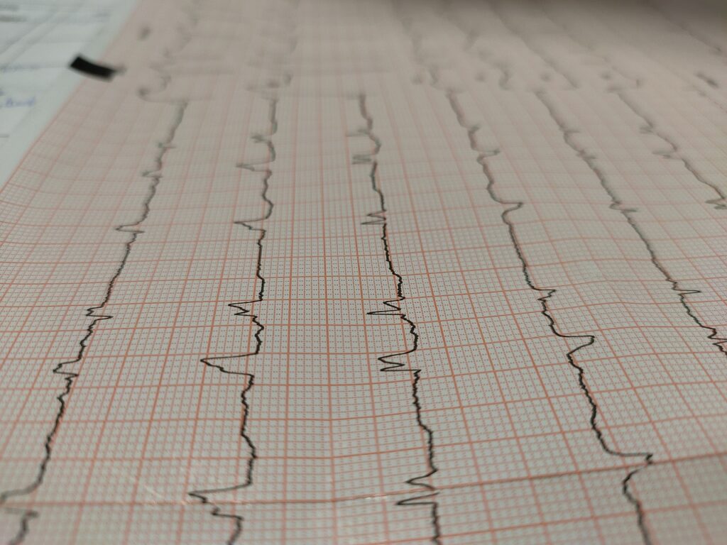 electrocardiogram, heart attack, tracing